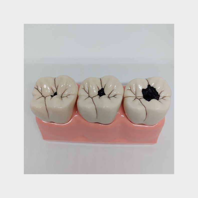 Stor Caries Studiemodel 